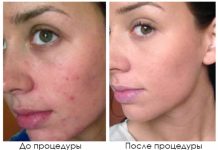 РФ лифтинг — и пусть старость подождет