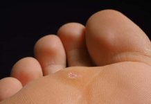 Что такое подошвенная бородавка и как от нее избавиться