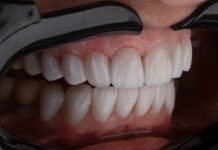 Отбеливание зубов ZOOM 4: Ослепительная улыбка в один сеанс